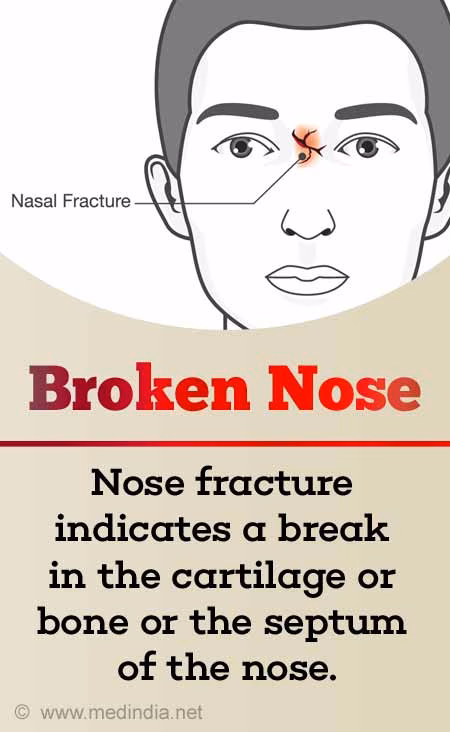 broken nose nasal fracture